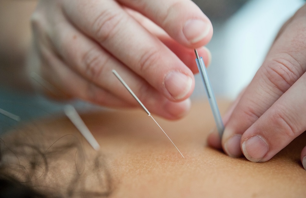 Dry needling Ashburn VA